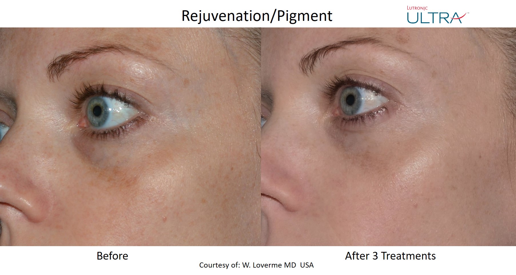 LaseMD Ultra before and after - Rejuvenation and pigment treatment
